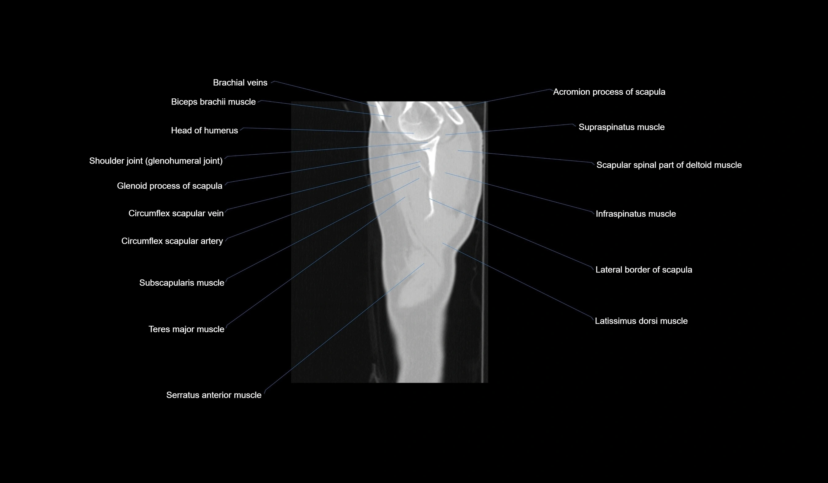 CT chest (thorax) lung window labelled sagittal cross sectional anatomy radiology image-00008.webp